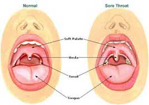 angina