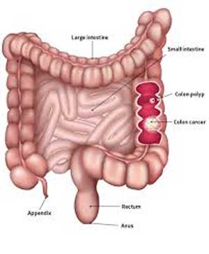 Colorectal cancer screening: life-saving screening.